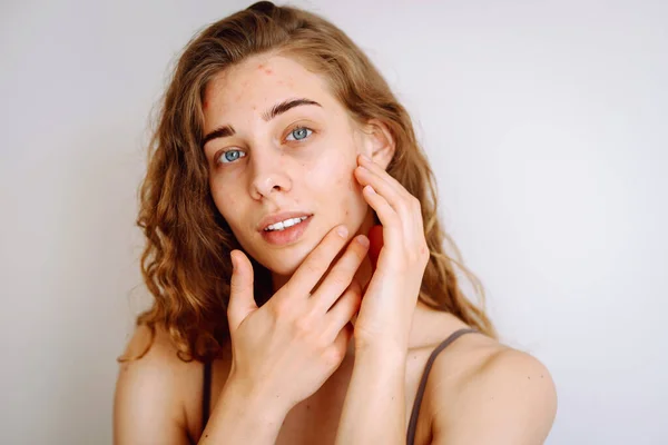 Close Portrait Beautiful Woman Makeup Imperfect Skin Acne Skin Natural — Stock Photo, Image