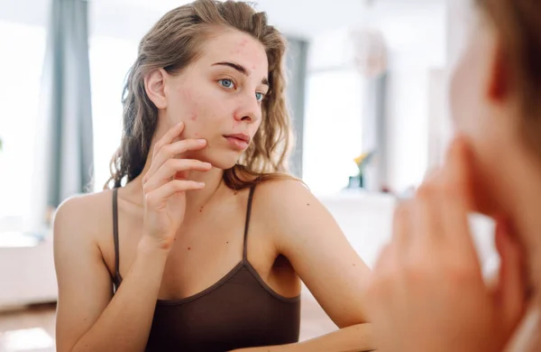 A young woman looks in the mirror examining inflammation on her face. Acne skin. Copy space. Medicine and cosmetology.