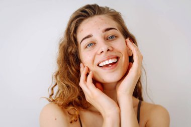 Yüzünde kızarıklık ve sivilcelerle gülümseyen bir kadının yakın çekimi. Tıp ve kozmetoloji. Boşluğu kopyala.