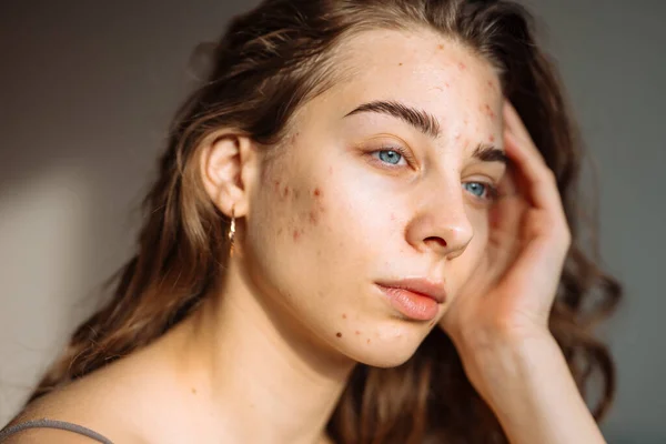 Wanita Muda Menyentuh Jerawat Wajahnya Merasa Kesal Karena Masalah Kulit Stok Foto Bebas Royalti