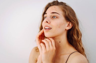 Derisi sorunlu genç bir kadın. Sivilceli bir hayat. Derisi kızarıklığa, sivilceye ve yaralara yatkın. Dermatoloji ve kozmetoloji kavramı.