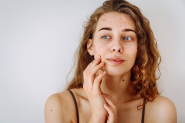 Derisi sorunlu genç bir kadın. Sivilceli bir hayat. Derisi kızarıklığa, sivilceye ve yaralara yatkın. Dermatoloji ve kozmetoloji kavramı.