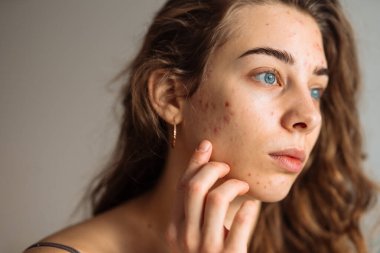Derisi sorunlu genç bir kadın. Sivilce tedavisi. Dermatoloji, kozmetoloji, cilt bakımı.