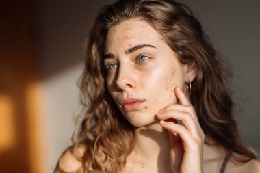 Derisi sorunlu genç bir kadın. Sivilce tedavisi. Dermatoloji, kozmetoloji, cilt bakımı.