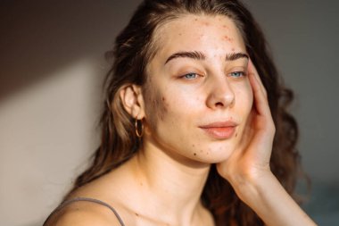 Derisi sorunlu genç bir kadın. Sivilce tedavisi. Dermatoloji, kozmetoloji, cilt bakımı.