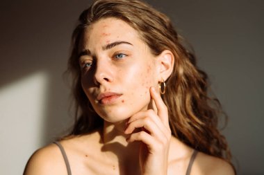 Derisi sorunlu genç bir kadın. Sivilce tedavisi. Dermatoloji, kozmetoloji, cilt bakımı.