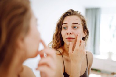 Yüzünde sivilceler olan genç bir kadın. Sivilceli bir hayat. Derisi kızarıklığa, sivilceye ve yaralara yatkın. Dermatoloji ve kozmetoloji kavramı. Alerji konsepti. 