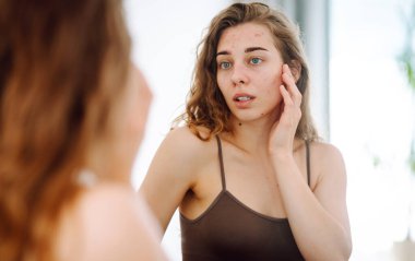 Yüzünde sivilceler olan genç bir kadın. Sivilceli bir hayat. Derisi kızarıklığa, sivilceye ve yaralara yatkın. Dermatoloji ve kozmetoloji kavramı. Alerji konsepti. 