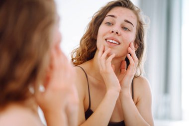 Yüzünde sivilceler olan genç bir kadın. Sivilceli bir hayat. Derisi kızarıklığa, sivilceye ve yaralara yatkın. Dermatoloji ve kozmetoloji kavramı. Alerji konsepti. 