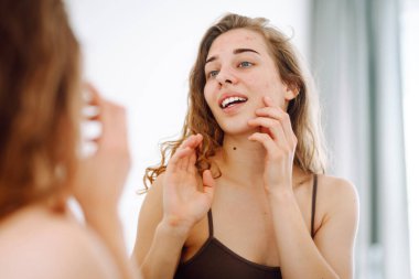 Yüzünde sivilceler olan genç bir kadın. Sivilceli bir hayat. Derisi kızarıklığa, sivilceye ve yaralara yatkın. Dermatoloji ve kozmetoloji kavramı. Alerji konsepti. 