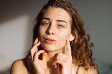 Derisi sorunlu genç bir kızın portresi. Yüzünde sivilceler var. Yüz bakımı. Sivilce sorunu.