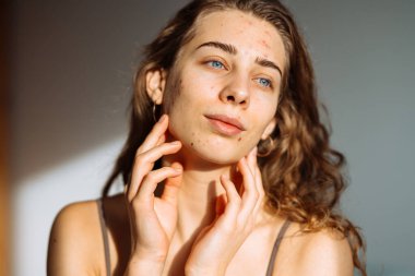 Derisi sorunlu genç bir kızın portresi. Yüzünde sivilceler var. Yüz bakımı. Sivilce sorunu.