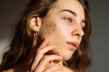 Derisi sorunlu genç bir kızın portresi. Yüzünde sivilceler var. Yüz bakımı. Sivilce sorunu.