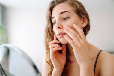 Derisi sorunlu genç bir kızın portresi aynaya bakıyor. Yüzünde sivilceler var. Yüz bakımı. Sivilce sorunu.