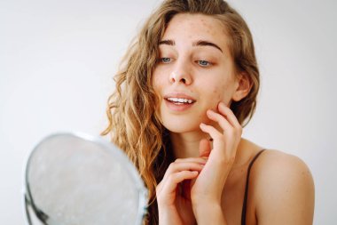 Derisi sorunlu genç bir kızın portresi aynaya bakıyor. Yüzünde sivilceler var. Yüz bakımı. Sivilce sorunu.