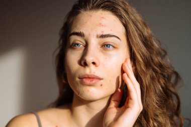 İsilik derisi, yara izi ve kozmetiğe alerjisi olan güzel bir genç kadının portresi. Tıp ve kozmetoloji kavramı.