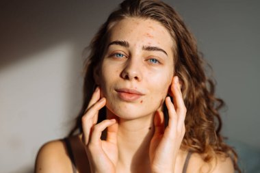 İsilik derisi, yara izi ve kozmetiğe alerjisi olan güzel bir genç kadının portresi. Tıp ve kozmetoloji kavramı.