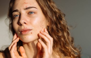 İsilik derisi, yara izi ve kozmetiğe alerjisi olan güzel bir genç kadının portresi. Tıp ve kozmetoloji kavramı.