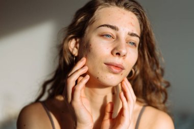 Kadının yüzündeki sivilceler ve sivilceler. Tıp ve kozmetoloji kavramı. Doğal cilt.