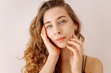 Cildi kötü olan genç bir kadın. Bir sürü sivilceli cilt. Sivilce hastalığı, sivilce tedavisi. Tıp ve kozmetoloji.