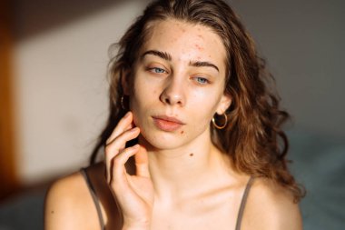 Sivilceli genç bir kadın. Dermatoloji, kozmetoloji, cilt bakımı. Doğal cilt.