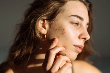 Sivilceli genç bir kadın. Dermatoloji, kozmetoloji, cilt bakımı. Doğal cilt.