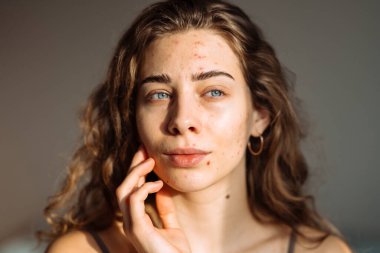 Yüzünde isilik, yara izi ve kozmetiğe alerjisi olan bir kadın sivilcesi. Tıp ve kozmetoloji kavramı. Doğal cilt.