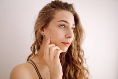 Yüzünde kırmızı lekeler olan bir kadın. Sağlık sorunları, deri hastalıkları. Tıp ve kozmetoloji kavramı.