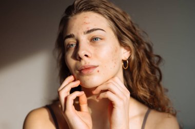 Yüzünde sorun olan bir kadın. Tıp ve kozmetoloji kavramı. Doğal cilt.