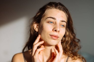 Yüzünde sorun olan bir kadın. Tıp ve kozmetoloji kavramı. Doğal cilt.