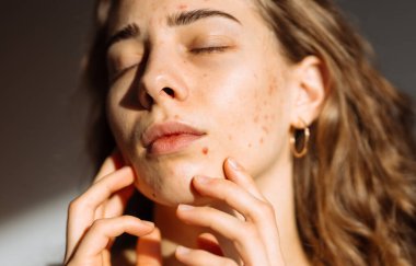 Yüzünde sorun olan bir kadın. Tıp ve kozmetoloji kavramı. Doğal cilt.