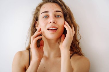 Kıvırcık saçlı ve mavi gözlü genç bir kadın sorunlu tenine nazikçe dokunuyor ve sakin bir ifade sergiliyor. Sivilceler. Sivilce hastalığı. Tıp ve kozmetoloji.