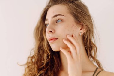 Derisi sorunlu güzel bir genç kız. Dalgalı saçlı genç bir kadın yüzüne hafifçe dokunuyor. Dermatoloji, kozmetoloji, cilt bakımı. Doğal cilt.
