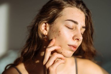 Yüzünde iltihaplar olan güzel bir genç kadının portresi. Tıp ve kozmetoloji kavramı. Doğal cilt.