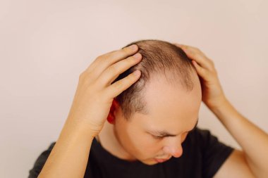 Orta yaşlı bir adamın kafasında kellik. Saç dökülmesi. Erkek saç dökülmesi, erken kellik ve saç dökülmesi sorunu..