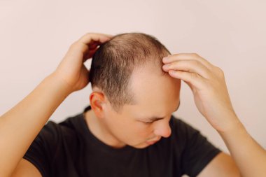 Kelleşmekten korkan genç beyaz bir adam, yaklaşın. Kellik, erkeklerde saç dökülmesi, erkeklerde saç dökülmesi sorunu..