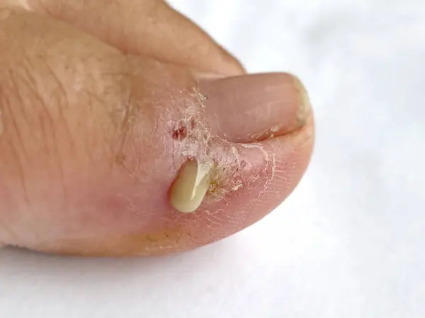 Sağlık kavramı - enfeksiyon kapmış deri alerjisi yarası, başparmak parmağı, iltihap apsesi. Stok fotoğrafı.