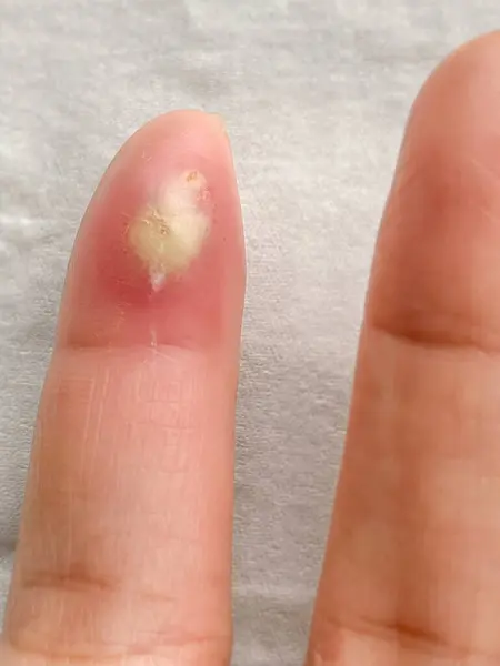 Alerjik deri arka planında enfekte olmuş bir yara. Sağlık sigortası kavramı. Stok fotoğrafı.