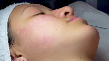 Dermatolog elleri sivilceleri ve siyah noktaları temizliyor. Kolombiyalı Latin bir kızın klinikte lambası, büyüteci, yüz bakımı, cilt bakımı....