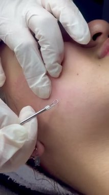 Dermatolog elleri sivilceleri ve siyah noktaları temizliyor. Kolombiyalı Latin bir kızın klinikte lambası, büyüteci, yüz bakımı, cilt bakımı....