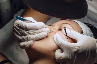 Dermatolog ellerinin sivilceleri ve sivilceleri temizlerken çekilmiş fotoğrafı. Klinikte lambalı ve büyüteçli Kolombiyalı Latin bir kızın sivilce temizleme aleti. Yüz bakımı, cilt bakımı..