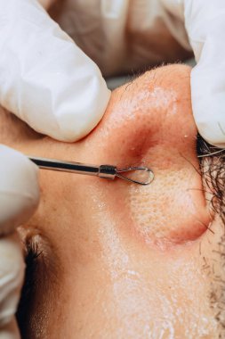 Yüz bakımı kliniğinde sakallı, Kolombiyalı mestizalı bir adamın sivilce temizleme aleti ile sivilce temizleyen dermatolog ellerinin yakın plan fotoğrafı..