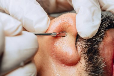 Yüz bakımı kliniğinde sakallı, Kolombiyalı mestizalı bir adamın sivilce temizleme aleti ile sivilce temizleyen dermatolog ellerinin yakın plan fotoğrafı..