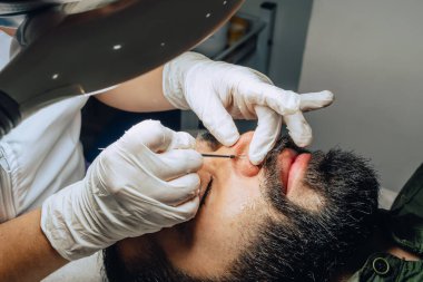Yüz bakımı kliniğinde sakallı, Kolombiyalı mestizo adamın sivilce temizleme aleti ile sivilce ve siyah nokta temizleme yapan dermatologun fotoğrafı..