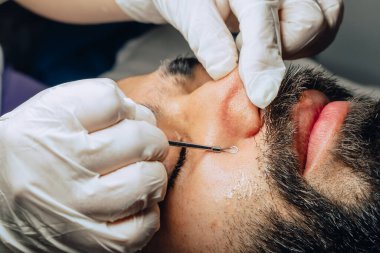 Yüz bakımı kliniğinde sakallı, Kolombiyalı mestizo adamın sivilce temizleme aleti ile sivilce ve siyah nokta temizleme yapan dermatologun fotoğrafı..