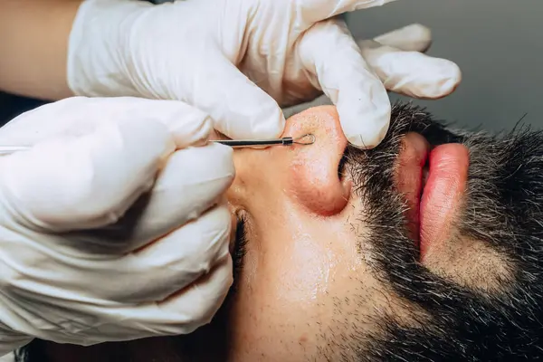 Yüz bakımı kliniğinde sakallı, Kolombiyalı mestizalı bir adamın sivilce temizleme aleti ile sivilce temizleyen dermatolog ellerinin yakın plan fotoğrafı..