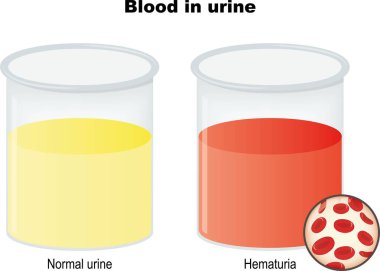 İdrarlı iki beher. Normal ve kanlı idrar. Hematüri, idrardaki kırmızı kan hücrelerinin (kırmızı renge neden olan) varlığıdır. Kırmızı kan hücrelerinin vektör diyagramı