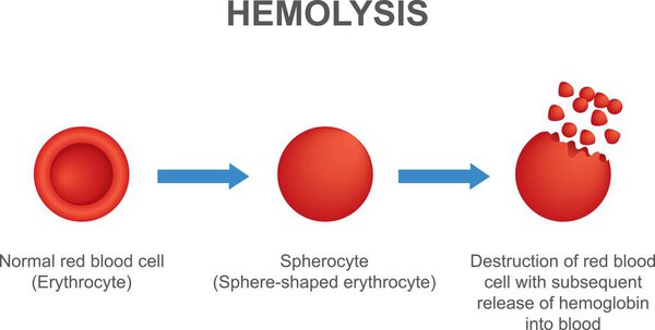 Hemolysis. Normal red blood cell, spherocyte, then destruction of red blood cell with subsequent release of hemoglobin into blood. Vector illustration isolated on white background.