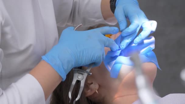 Dentista Prepara Sciarpa Lattice Con Sequenze Metallo Trattamento Canali Pulpite — Video Stock