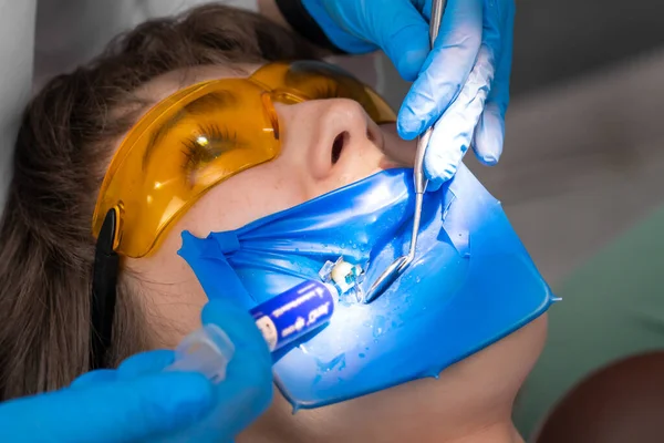 Stosuję Zębach Kompozytowe Wypełnienie Bazie Żywicy Młoda Kobieta Klinice Dentystycznej — Zdjęcie stockowe